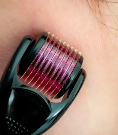 2mm titanium derma roller for acne scars and hair regrowth - obeepo.in
