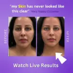 Live result of Aura EMS Light Therapy Face Massager live results - obeepo.in