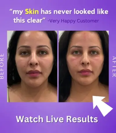 Live result of Aura EMS Light Therapy Face Massager live results - obeepo.in